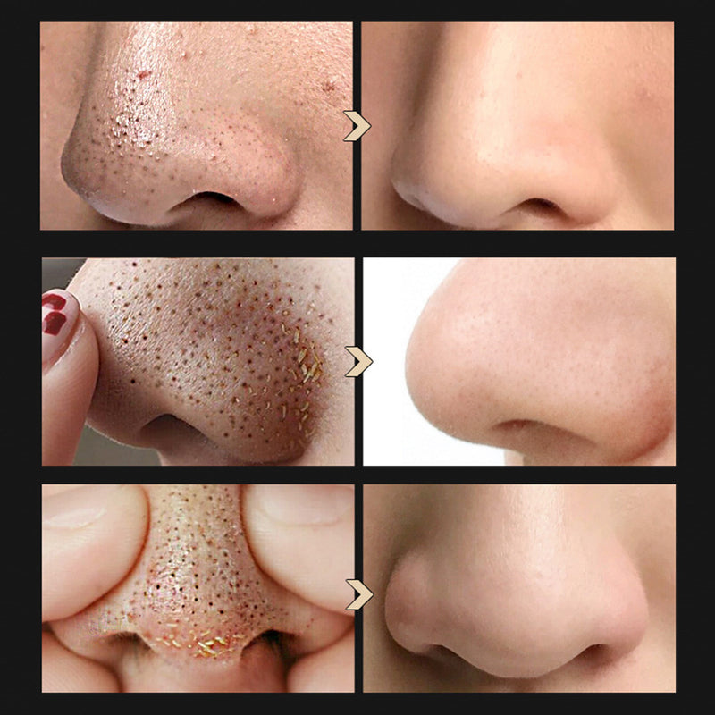 Blackhead-Clearing Kit — Shrinks Pores, Clears Congestion